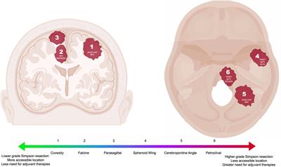 Corrigendum: Identification and management of aggressive meningiomas